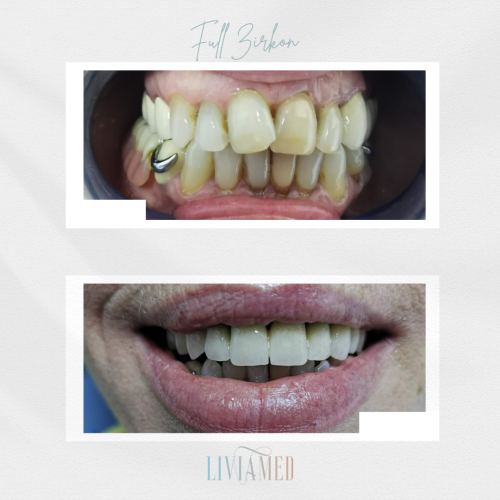 Implant Dentar