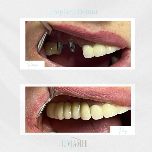 Implant Dentar