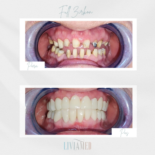 Implant Dentar